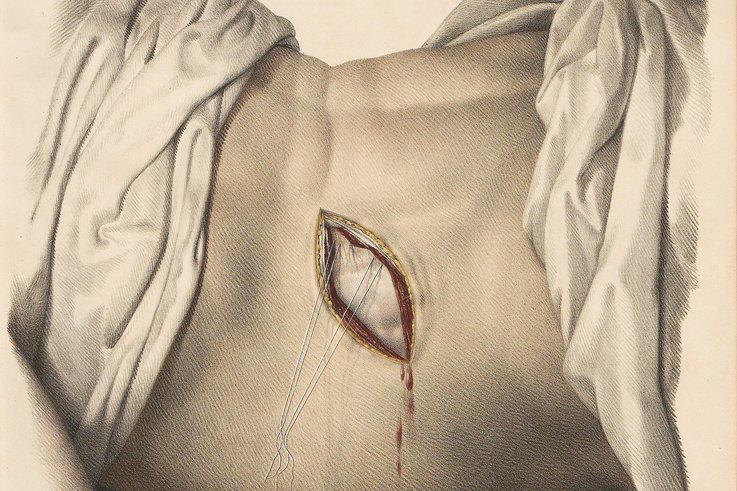 Anatomische Zeichnung eines geöffneten Bauches mit sichtbarer Blutung und chirurgischen Nähten, von Tüchern umrahmt.